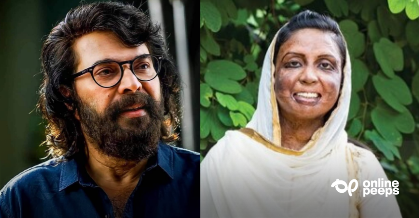 പൊള്ളലേറ്റ ഷാഹിനയ്ക്ക് സൗജന്യ ചികിത്സാ സഹായവുമായി മമ്മൂട്ടി